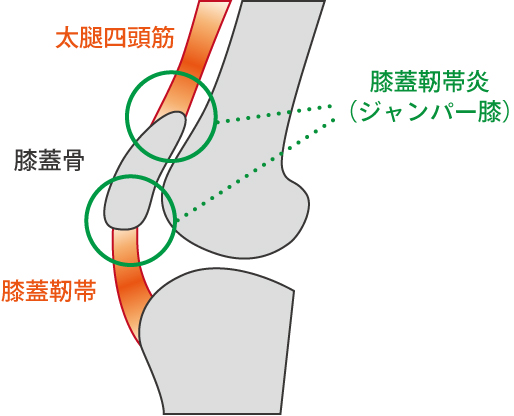 ジャンパー膝