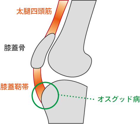 オスグッド病